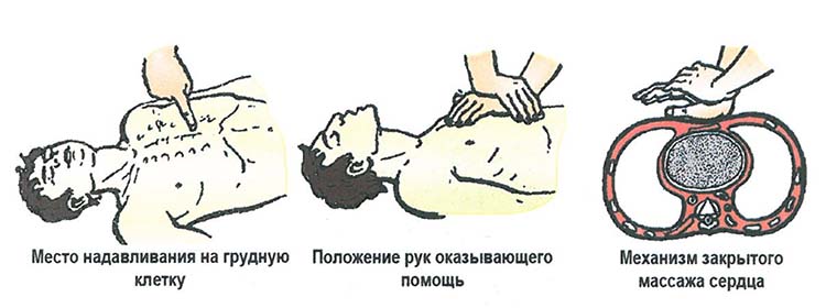 Как следует расположить руки на грудной клетке. Место надавливания на грудную клетку при закрытом массаже сердца. Надавливание на грудную клетку при закрытом массаже. Надавливание на грудную клетку при закрытом массаже сердца. Закрытый массаж сердца проводят надавливанием на.